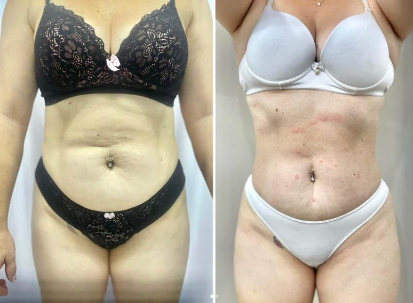 Estética corporal - Resultados